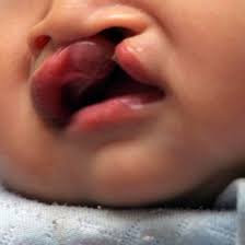 Smiles Initiative poised to eliminate cleft lips in Kano