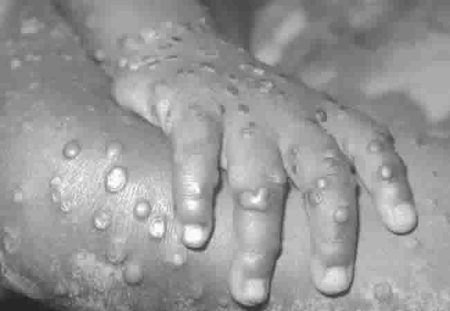 62 monkeypox cases confirmed in 19 states – NCDC