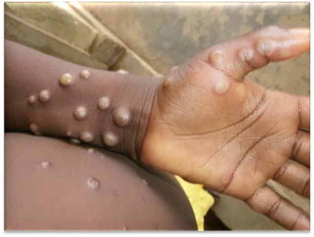 NCDC announces 21 monkey pox cases in 7 days