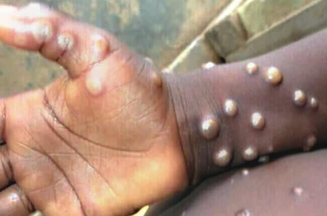 Monkeypox: China advises against contact with foreigners