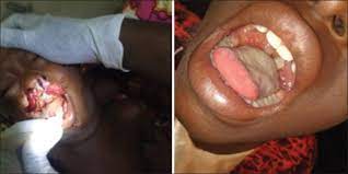 JUST IN: Diphtheria outbreak kills many in Kano