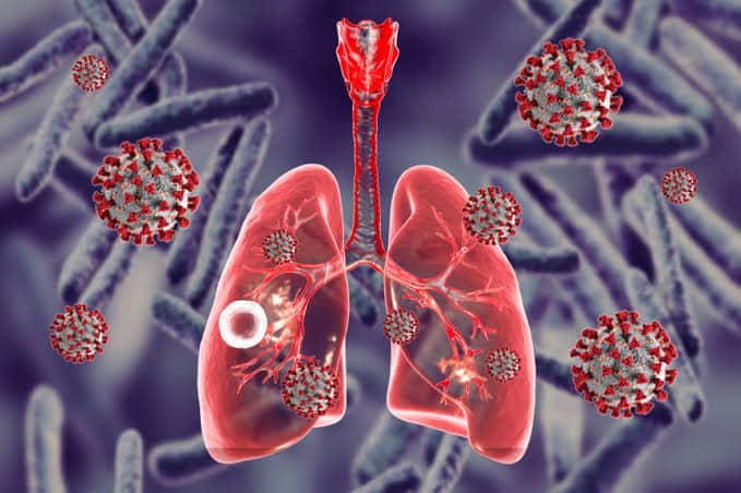 Bauchi records 7,806 cases of tuberculosis