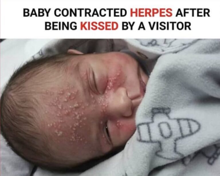 A Baby contracts Herpes